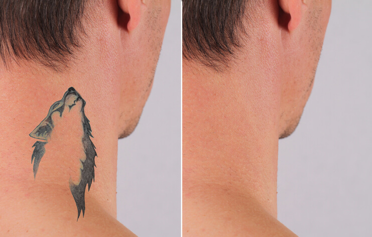 Why More People in Melbourne Are Choosing Laser Tattoo Removal?